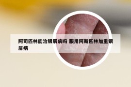 阿司匹林能治銀屑病嗎 服用阿斯匹林加重銀屑病
