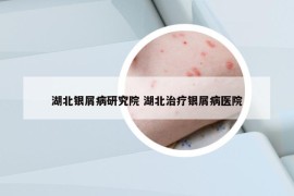 湖北銀屑病研究院 湖北治療銀屑病醫(yī)院