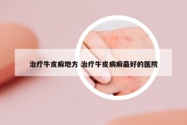 治療牛皮癬地方 治療牛皮病癬最好的醫(yī)院