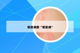 銀屑病婁 "銀屑病"