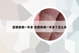 患銀屑病一年多 患銀屑病一年多了怎么辦
