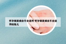 懷孕銀屑病會不會遺傳 懷孕銀屑病會不會遺傳給胎兒