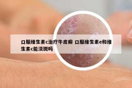 口服維生素c治療牛皮癬 口服維生素e和維生素c能淡斑嗎