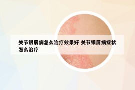 關節(jié)銀屑病怎么治療效果好 關節(jié)銀屑病癥狀怎么治療