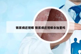 銀屑病近視眼 銀屑病近視眼會(huì)加重嗎