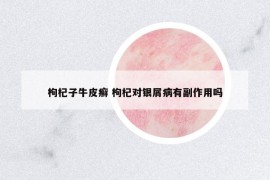 枸杞子牛皮癬 枸杞對(duì)銀屑病有副作用嗎