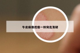 牛皮癬像疙瘩一樣突出發(fā)硬