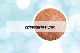 西安牛皮癬?？票狈綉c