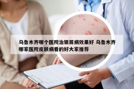 烏魯木齊哪個醫(yī)院治銀屑病效果好 烏魯木齊哪家醫(yī)院皮膚病看的好大家推薦