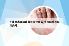 牛皮癬患者腦出血可以針灸么 牛皮膚癬可以針灸嗎
