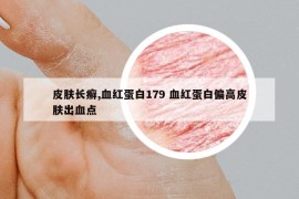 皮膚長(zhǎng)癬,血紅蛋白179 血紅蛋白偏高皮膚出血點(diǎn)