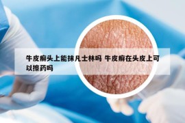 牛皮癬頭上能抹凡士林嗎 牛皮癬在頭皮上可以擦藥嗎