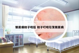 銀屑病蚊子咬后 蚊子叮咬引發(fā)銀屑病