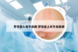 夢見別人有牛皮癬 夢見身上長牛皮膚病