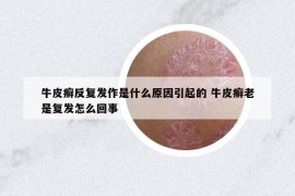 牛皮癬反復(fù)發(fā)作是什么原因引起的 牛皮癬老是復(fù)發(fā)怎么回事