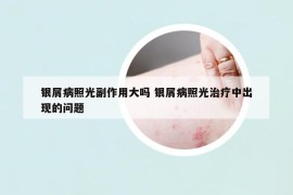 銀屑病照光副作用大嗎 銀屑病照光治療中出現(xiàn)的問(wèn)題