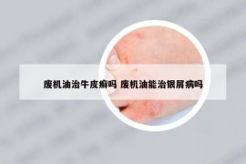 廢機(jī)油治牛皮癬嗎 廢機(jī)油能治銀屑病嗎