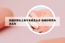 拍婚紗照頭上有牛皮癬怎么辦 拍婚紗照禿頭怎么辦