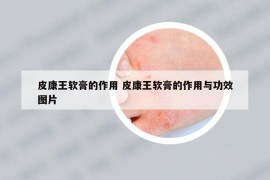 皮康王軟膏的作用 皮康王軟膏的作用與功效圖片