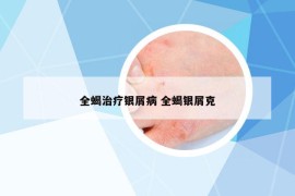 全蝎治療銀屑病 全蝎銀屑克