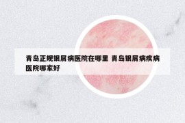 青島正規(guī)銀屑病醫(yī)院在哪里 青島銀屑病疾病醫(yī)院哪家好