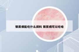 銀屑病能吃什么調(diào)料 銀屑病可以吃啥