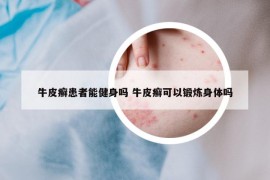 牛皮癬患者能健身嗎 牛皮癬可以鍛煉身體嗎