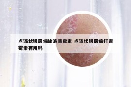 點滴狀銀屑病輸液青霉素 點滴狀銀屑病打青霉素有用嗎