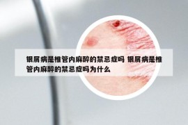 銀屑病是椎管內(nèi)麻醉的禁忌癥嗎 銀屑病是椎管內(nèi)麻醉的禁忌癥嗎為什么