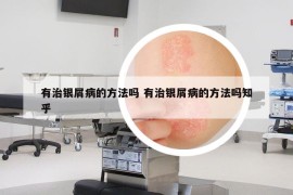 有治銀屑病的方法嗎 有治銀屑病的方法嗎知乎