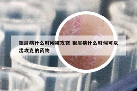 銀屑病什么時候被攻克 銀屑病什么時候可以出攻克的藥物