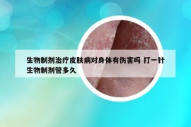 生物制劑治療皮膚病對(duì)身體有傷害嗎 打一針生物制劑管多久