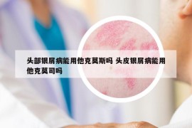 頭部銀屑病能用他克莫斯嗎 頭皮銀屑病能用他克莫司嗎