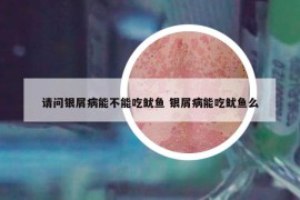 請問銀屑病能不能吃魷魚 銀屑病能吃魷魚么