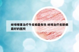 蚌埠哪里治療牛皮癬最有效 蚌埠治療皮膚病最好的醫(yī)院