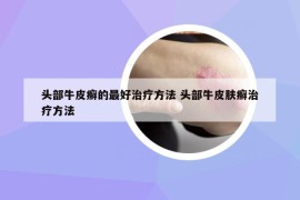 頭部牛皮癬的最好治療方法 頭部牛皮膚癬治療方法