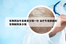 生物劑治牛皮癬多少錢一針 治療牛皮膚癬的生物制劑多少錢