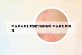 牛皮癬可以打封閉針有影響嗎 牛皮廨打封閉針