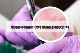 銀屑病可以接觸蝦皮嗎 銀屑病患者能吃蝦嗎