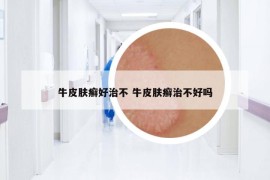 牛皮膚癬好治不 牛皮膚癬治不好嗎