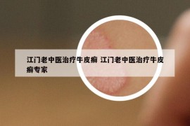 江門(mén)老中醫(yī)治療牛皮癬 江門(mén)老中醫(yī)治療牛皮癬專家