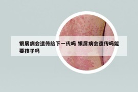 銀屑病會(huì)遺傳給下一代嗎 銀屑病會(huì)遺傳嗎能要孩子嗎