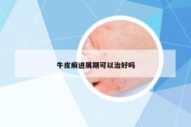 牛皮癬進(jìn)展期可以治好嗎