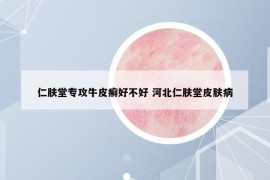 仁膚堂專攻牛皮癬好不好 河北仁膚堂皮膚病
