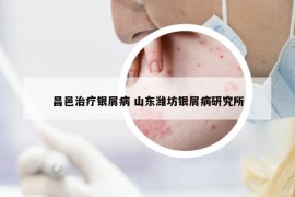 昌邑治療銀屑病 山東濰坊銀屑病研究所