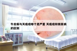 牛皮癬與天皰瘡哪個更嚴重 天皰瘡和銀屑病的區(qū)別