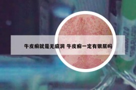 牛皮癬就是無底洞 牛皮癬一定有銀屑嗎