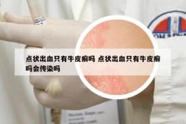 點狀出血只有牛皮癬嗎 點狀出血只有牛皮癬嗎會傳染嗎