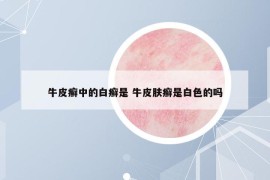 牛皮癬中的白癬是 牛皮膚癬是白色的嗎