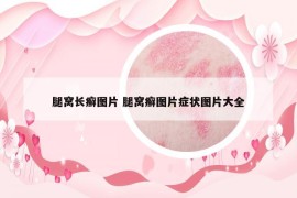 腿窩長癬圖片 腿窩癬圖片癥狀圖片大全